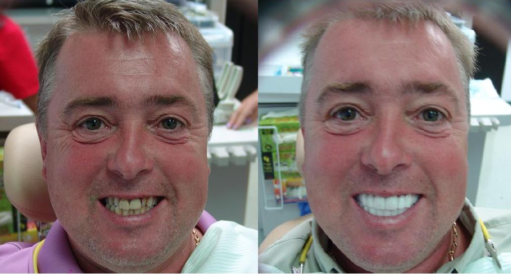 Actual Snap On Smile Patient